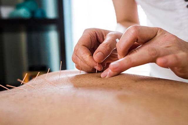 Acupuncture practitioner placing needles in a person's back.