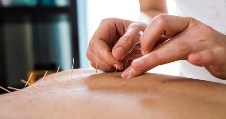 A close-up of acupuncture needles being inserted into a patient's back.