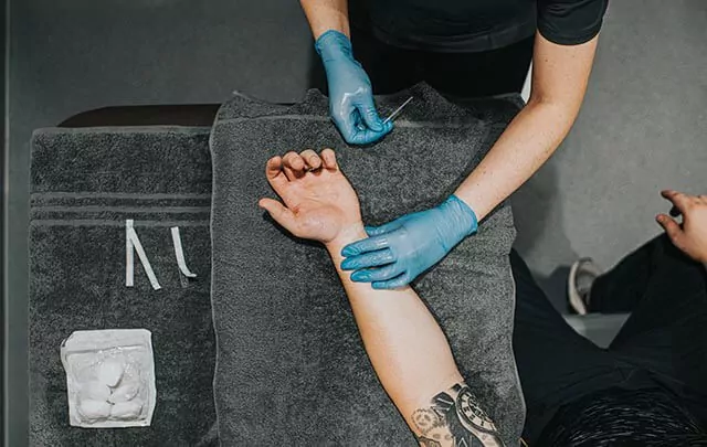 Acupuncture treatment on a forearm, with cotton balls and tape placed nearby, a client is lying down on a towel.